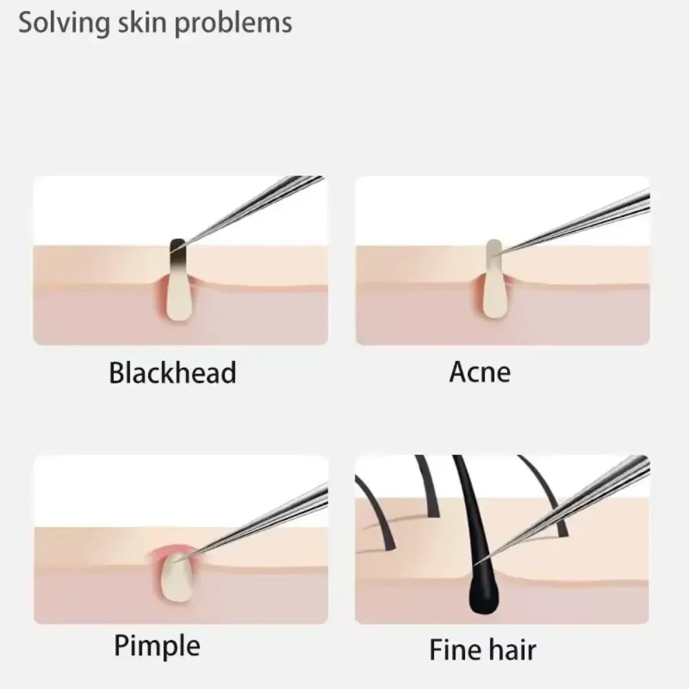 11Pcs Pro Acne Needles Blackhead Remover Ultra-fine No. 5 Cell Clips Pimples Tweezers Facial Pore Cleaning Face Skin Care Tools free Gift laptop stand