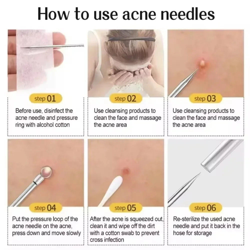 11Pcs Pro Acne Needles Blackhead Remover Ultra-fine No. 5 Cell Clips Pimples Tweezers Facial Pore Cleaning Face Skin Care Tools free Gift laptop stand