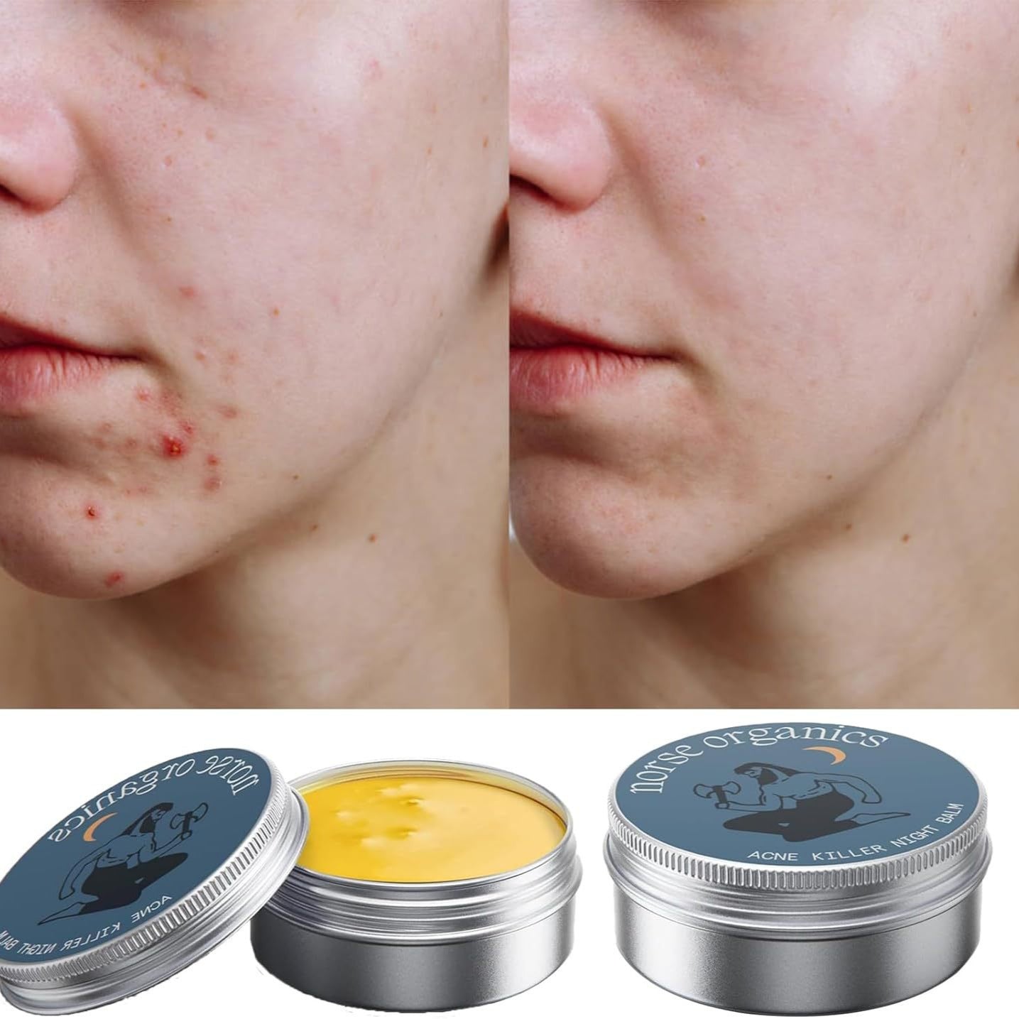 Acne Treatment Cream, Muscle Joint Skin Moisturizing Cream 100% pure naturel